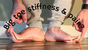 hallux rigidus